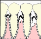 Cartoon of gums and teeth infected with gingivitis